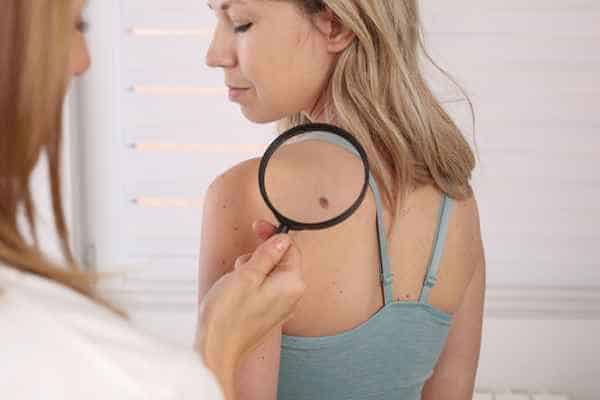 What Are Traditional Skin Lesion Removal Methods Biggleswade?