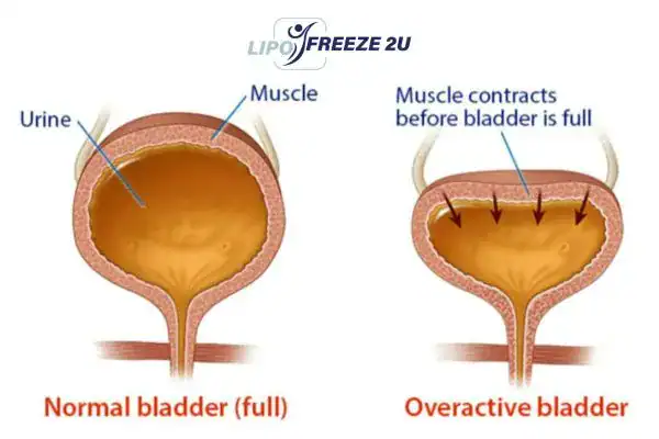 diagram of overactive bladder treatment Biggleswade