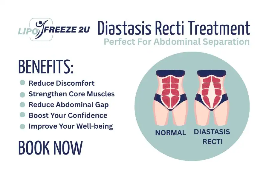 Benefits of body toning treatment Biggleswade for Diastasis recti