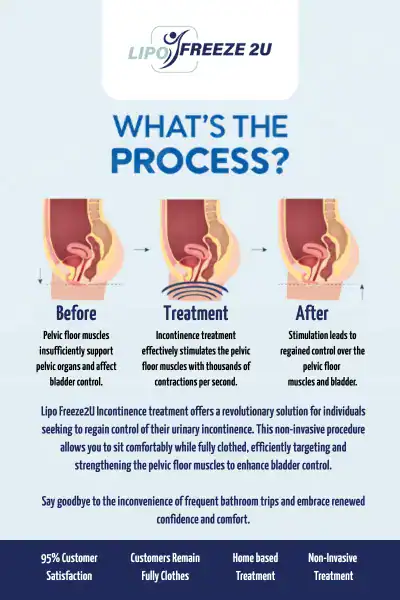 Diagram of how incontinence treatment Biggleswade works.