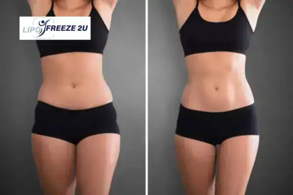 How Can LIPO FREEZE 2U Support Your Post-Pregnancy Body Recovery Biggleswade?
