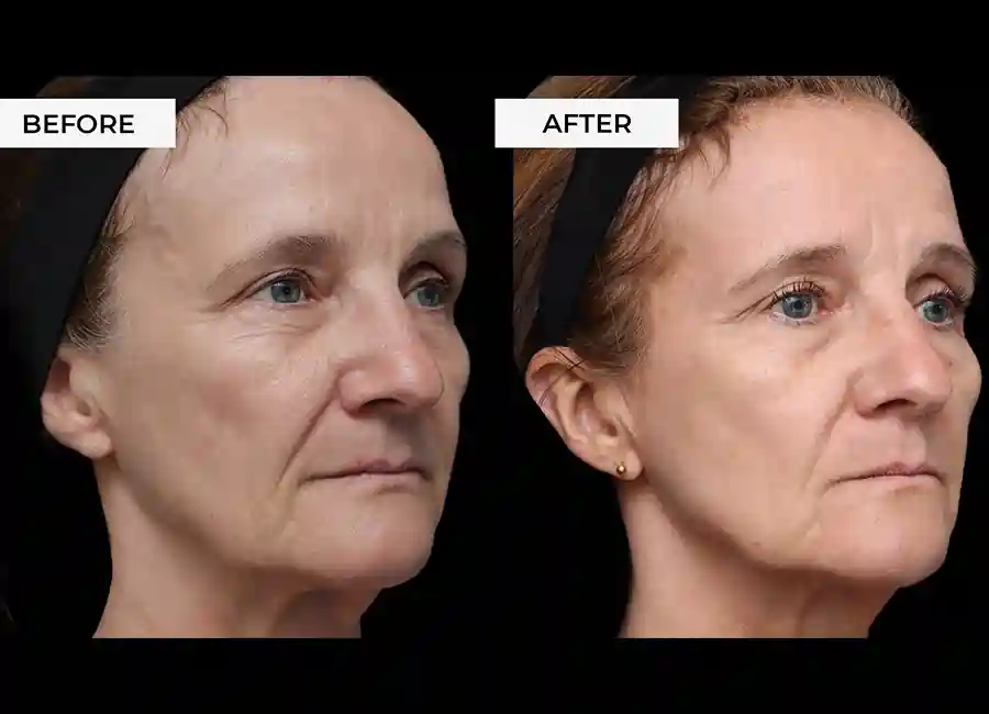 How Many RF Microneedling Sessions Will You Need to See a Difference Biggleswade?