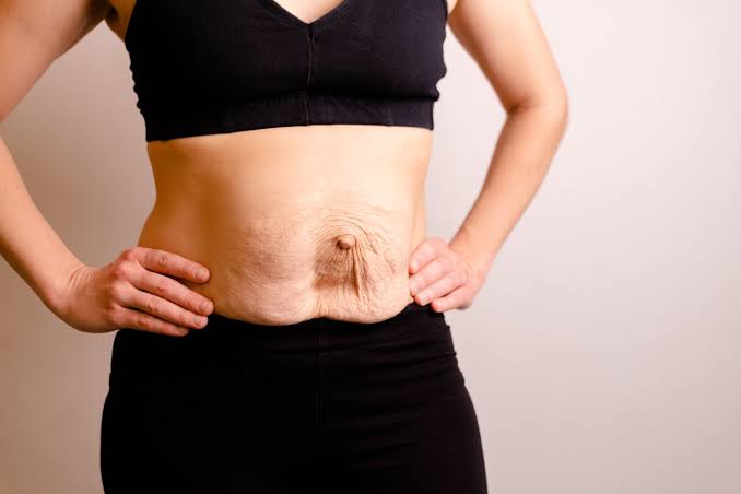 Is Surgery Really the Only Way to Repair Diastasis Recti Biggleswade?