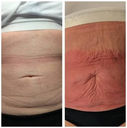 How Does RF Microneedling Improve Crepey, Thin and Uneven Skin Texture Biggleswade?