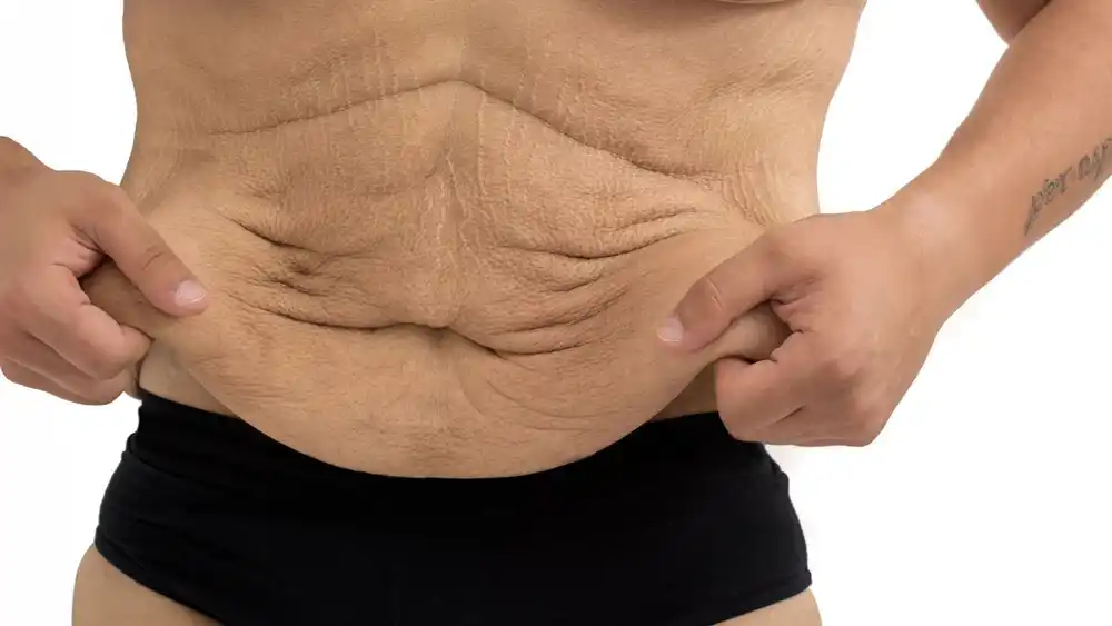 RF Microneedling for Loose Skin: How Can It Help Tighten and Reshape the Skin Biggleswade?